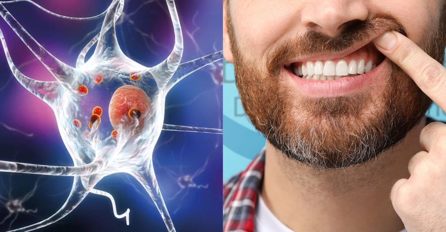 Batten Disease and Dental Health inblog
